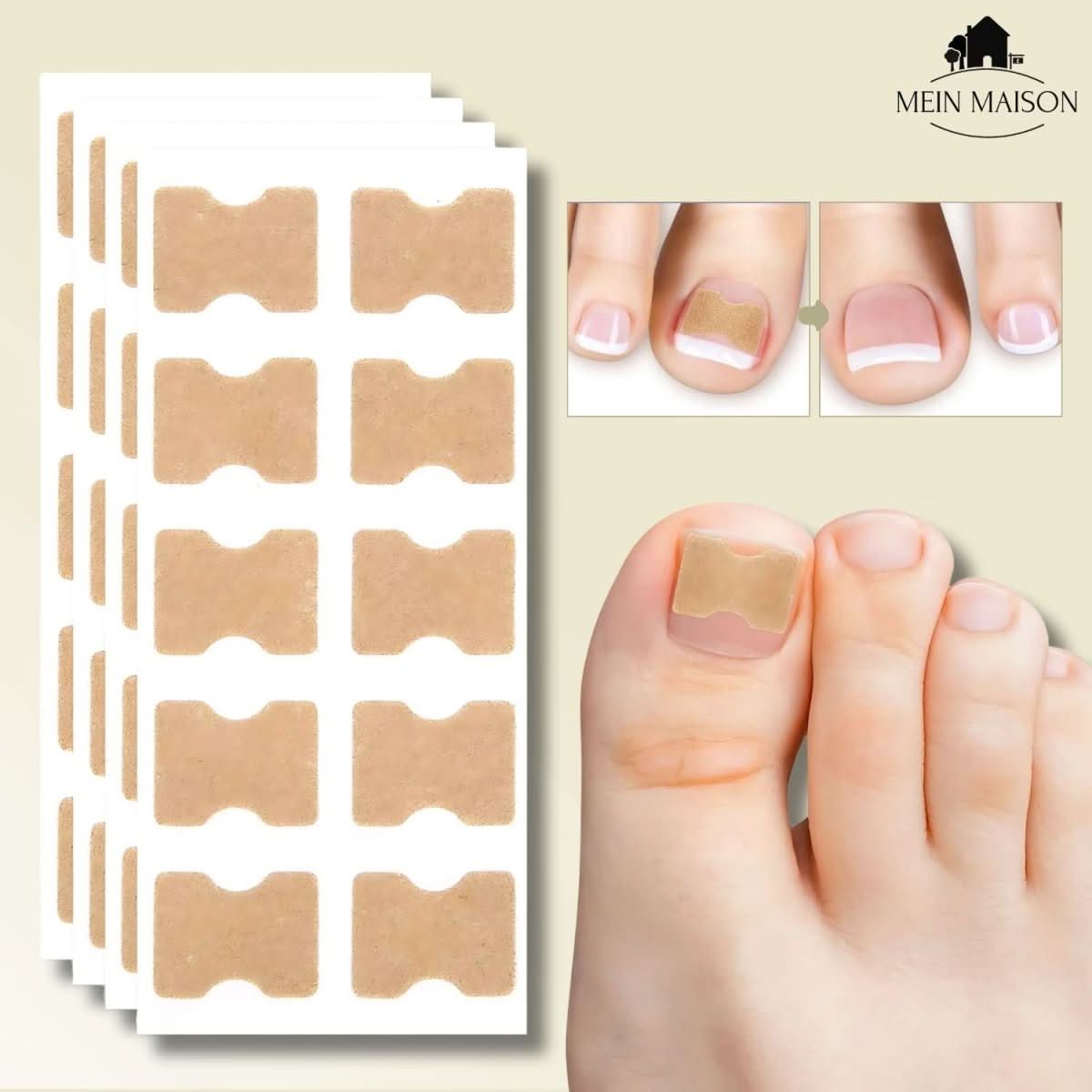 NovaNail Gentle Nail Correction for Ingrown Nails and Pain | Temsk