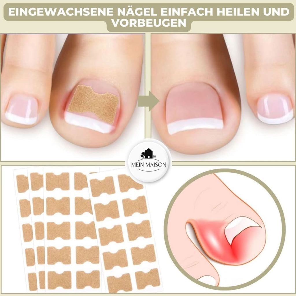 NovaNail Gentle Nail Correction for Ingrown Nails and Pain | Temsk