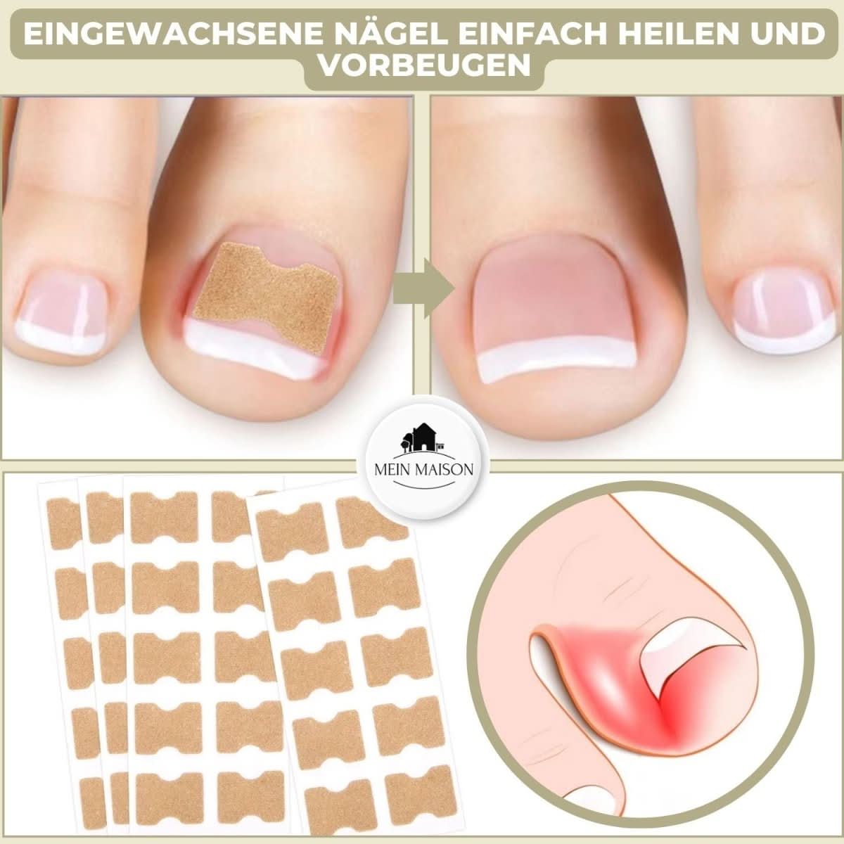 NovaNail Gentle Nail Correction for Ingrown Nails and Pain | Temsk
