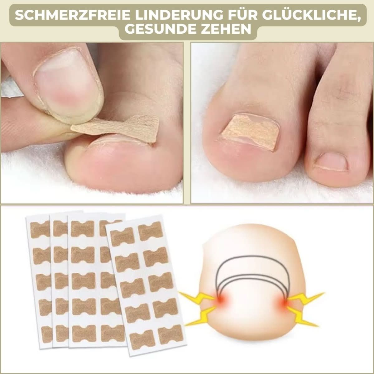 NovaNail Gentle Nail Correction for Ingrown Nails and Pain | Temsk