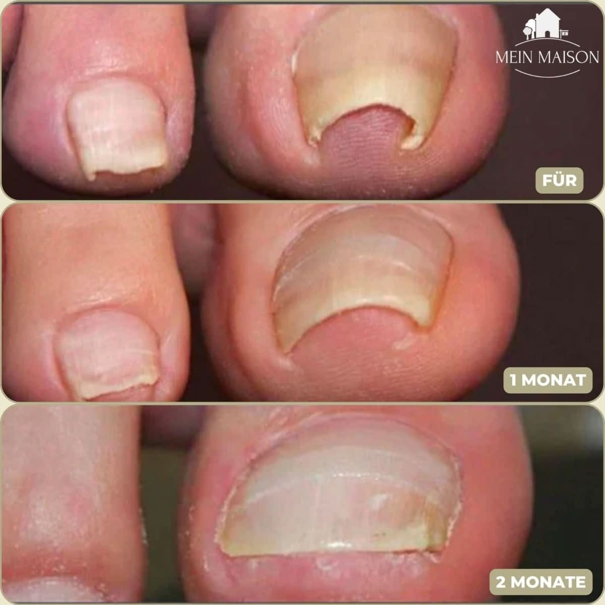 NovaNail Gentle Nail Correction for Ingrown Nails and Pain | Temsk