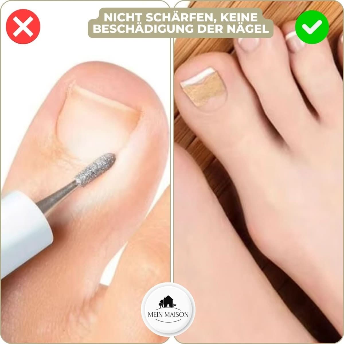 NovaNail Gentle Nail Correction for Ingrown Nails and Pain | Temsk