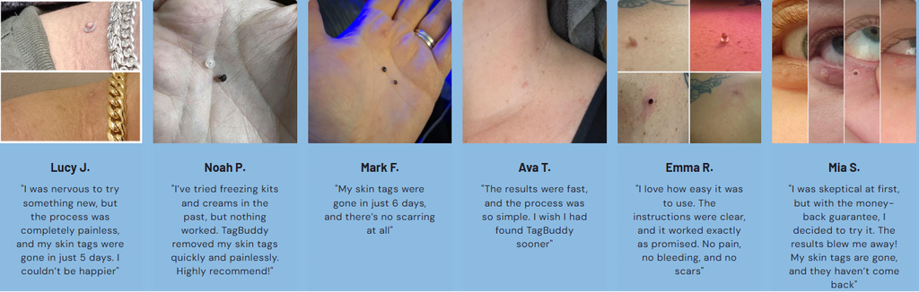 Skin Tag Removal Kit with Micro-Compression Bands | Temsk